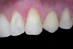 Studio-Denistico-Ortelli_implantologia_Implantologia-dente-singolo-DOPO