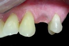 Studio-Denistico-Ortelli_implantologia_Implantologia-dente-singolo-PRIMA
