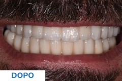 Studio Ortelli servizio All-on-four dettagli dentatura paziente dopo il trattamento