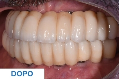 Studio Ortelli servizio All-on-four panoramica dentaria vista laterale dopo il trattamento