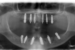 Implantologia All On Six panoramica dentaria dopo l'intervento
