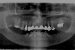 Implantologia All On Six panoramica dentaria prima dell'intervento
