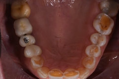 Riabilitazione completa in protesi fissa panoramica arcata dentaria superiore prima dell'intervento