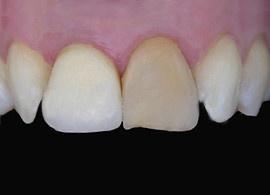 Sbiancamento dente singolo PRIMA