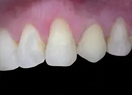 Implantologia dente singolo DOPO